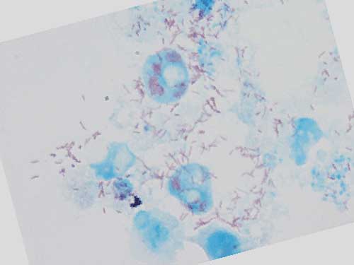bakteri rickettsia pemicu gejala tifus